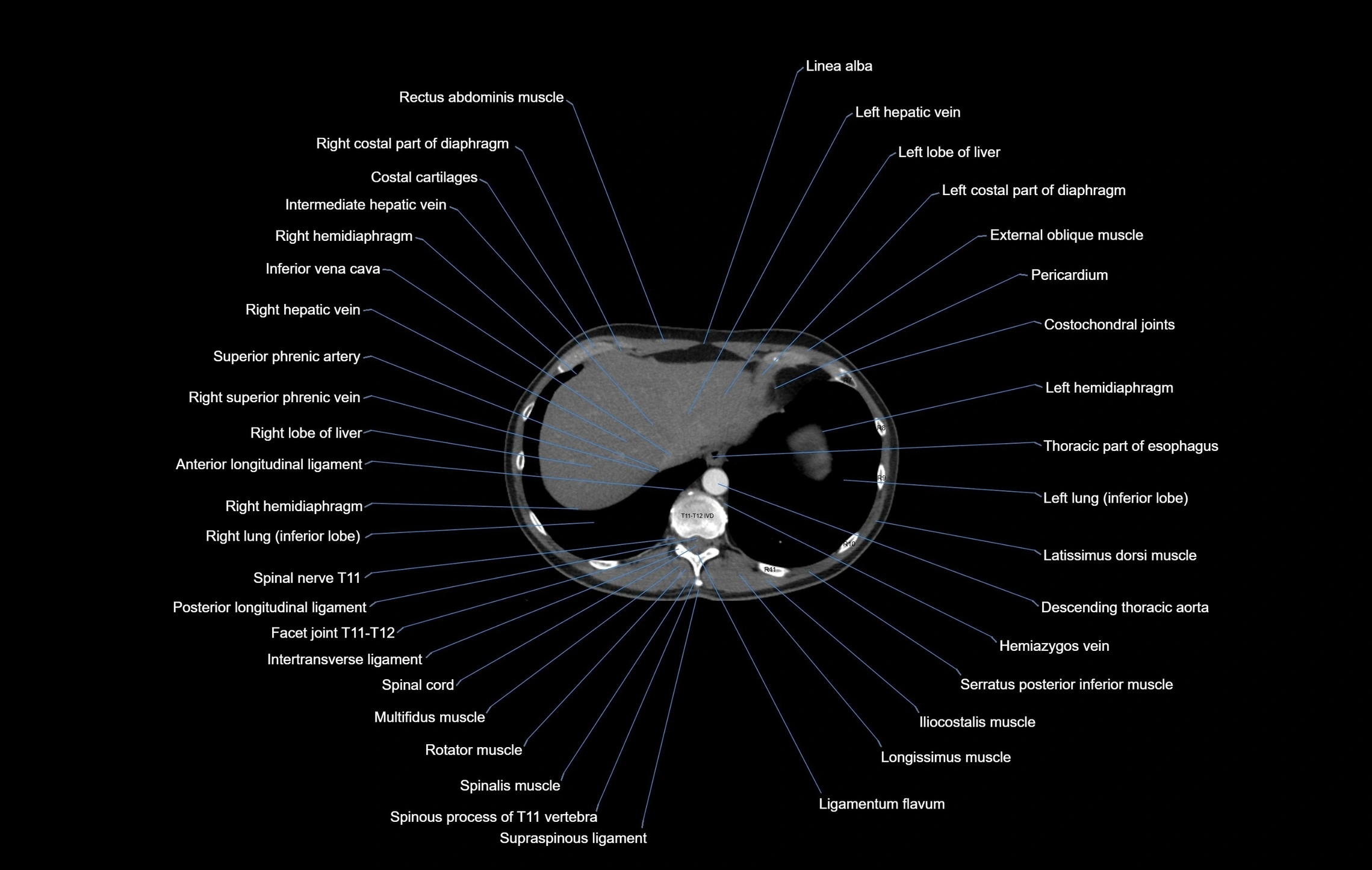 CT chest (thorax) labelled axial cross sectional anatomy radiology image-00104.webp